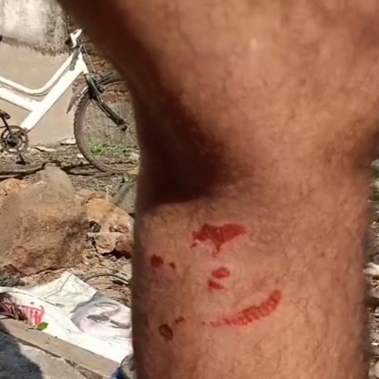 सिवनी के केवलारी में पालतू कुत्तों ने युवक को कटा:घायल ने मालिकों के खिलाफ थाने में शिकायत दर्ज कराई